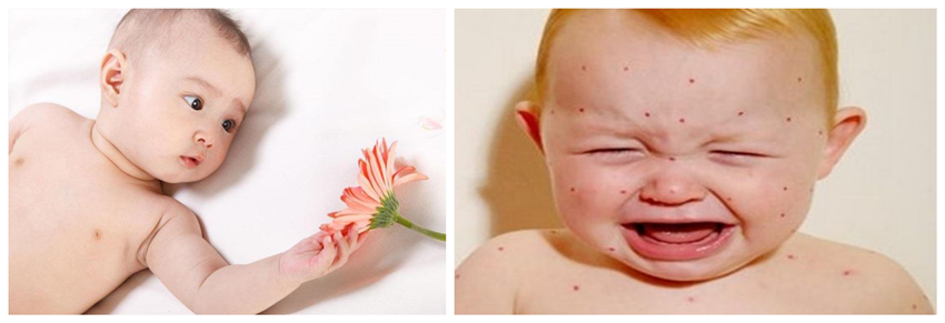 兒童濕疹反反復復，您有在家安裝家用除濕產品嗎？